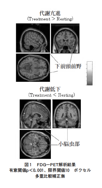 頸部痛患者におけるカイロプラクティック施術後の局所脳代謝変化：18F-FDG-PET研究の表紙