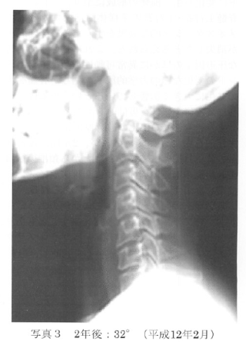 頚椎後縦靭帯骨化症に対する間接的アプローチの一例〜頚椎アライメントを指標として〜の表紙